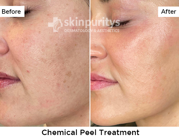 Chemical Peels results